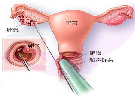  试管婴儿取卵到移植要多长时间 恰当时间最好