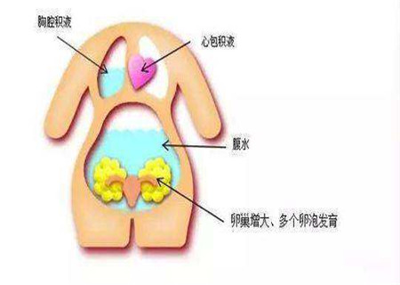 试管婴儿促排卵针打多久 不是越久越好