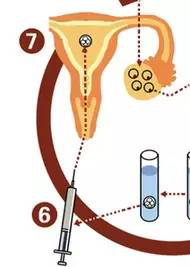 教你一张图看懂试管婴儿的治疗过程