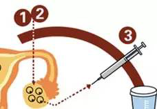 教你一张图看懂试管婴儿的治疗过程