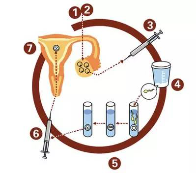 教你一张图看懂试管婴儿的治疗过程