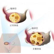 多囊卵巢综合症导致不孕能做试管婴儿吗?-杰特宁