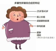 多囊卵巢综合症女性有些什么症状？-杰特宁医院