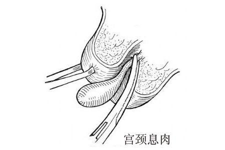 女性子宫腔内长有息肉的原因？